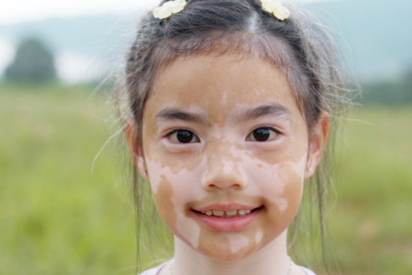 Niña pequeña con vitíligo